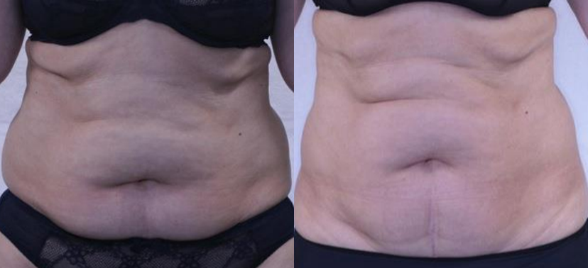 인모드  치료사례03