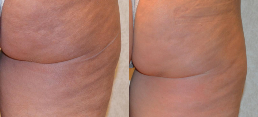 인모드  치료사례03