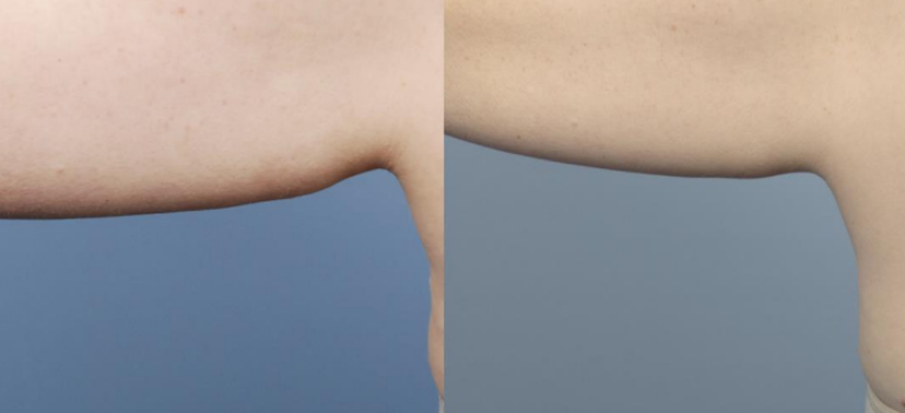 인모드  치료사례03