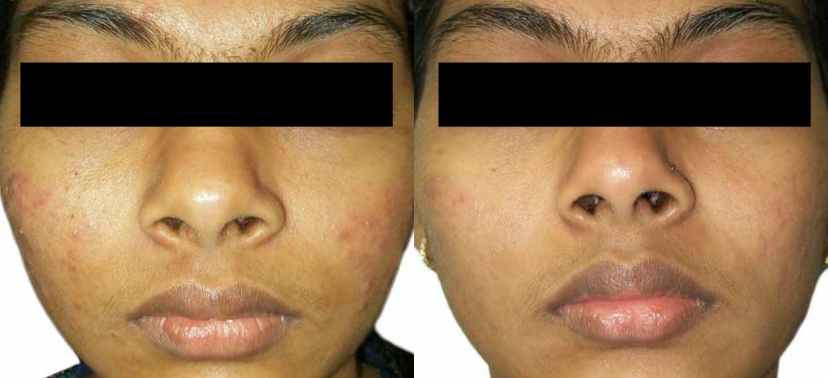 비너스비바 치료사례05