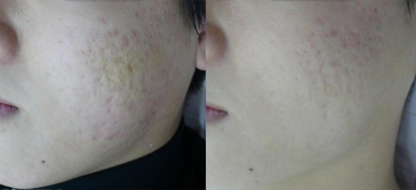 미인레이저 치료사례02