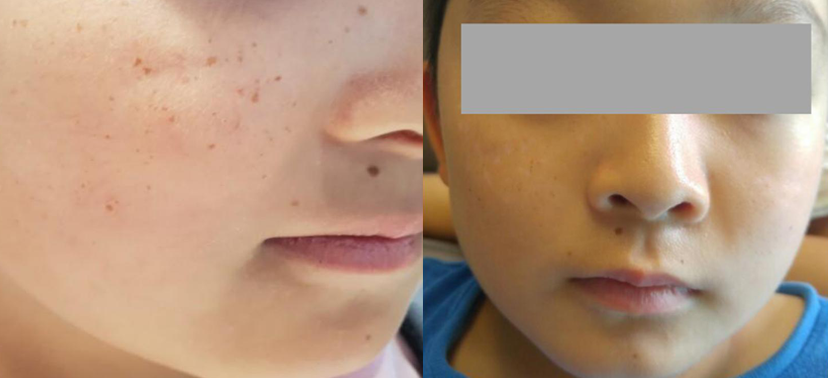 미인레이저 치료사례03