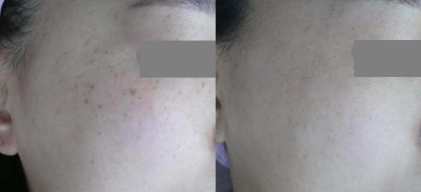 미인레이저 치료사례04