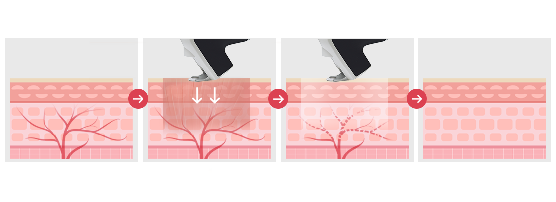 인모드 리프팅 핵심기술