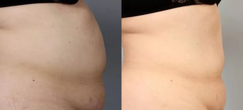 인모드 바디 치료사례01