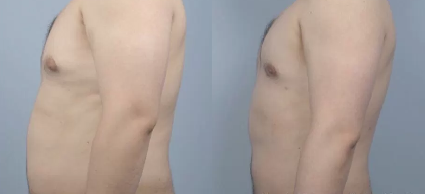 인모드 바디 치료사례02