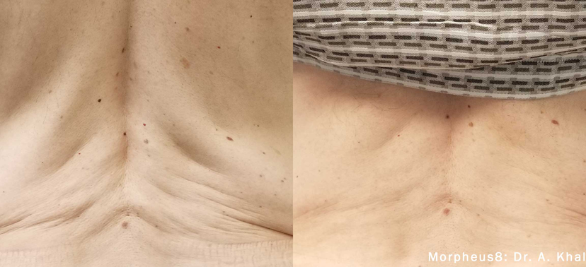 인모드 치료사례01