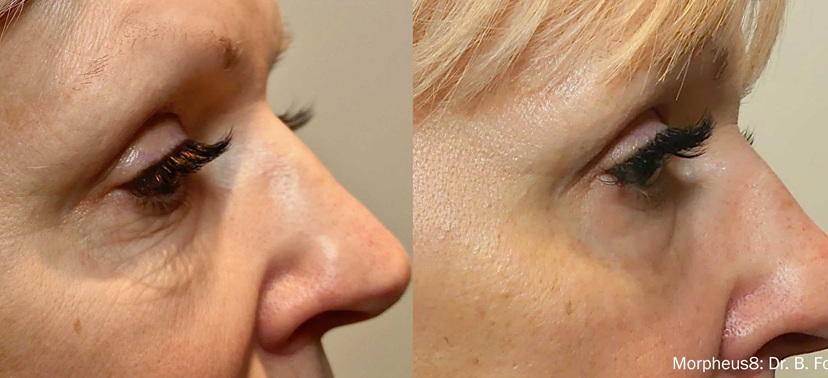 인모드 치료사례02