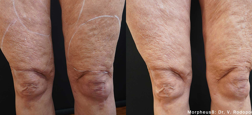 인모드 치료사례03