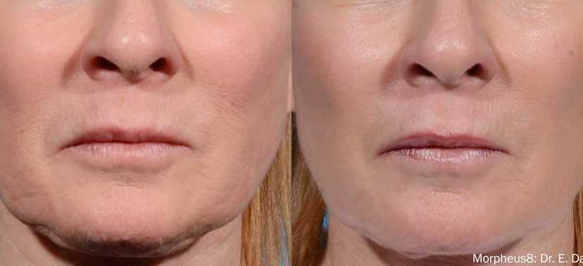 인모드 치료사례04