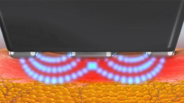 진피층 리프팅 콜라겐 생성