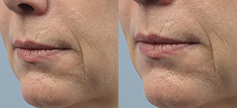 인모드  치료사례01