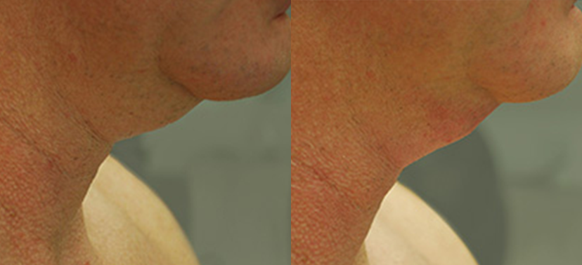 인모드  치료사례02