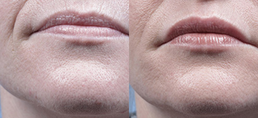 인모드  치료사례03