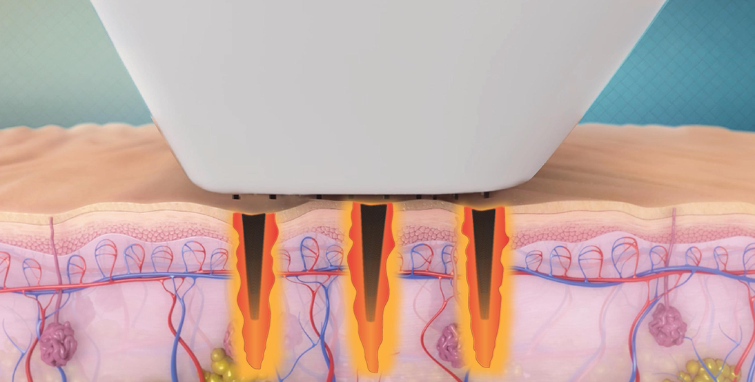 비너스비바 핸드피스 일러스트