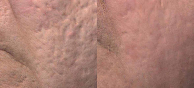 비너스비바 치료사례01