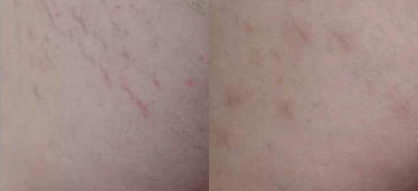 비너스비바 치료사례03