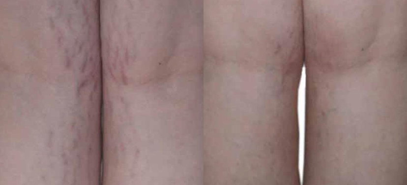 비너스비바 치료사례04