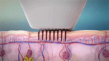 비너스비바 레이저