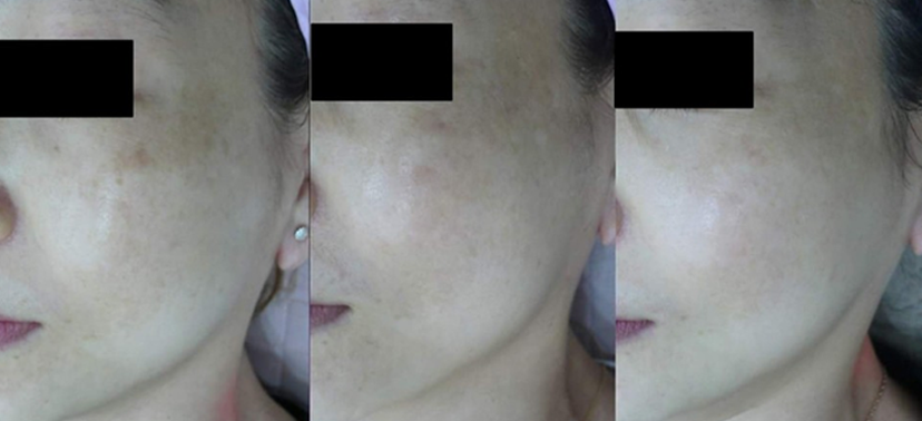 미인레이저 치료사례07