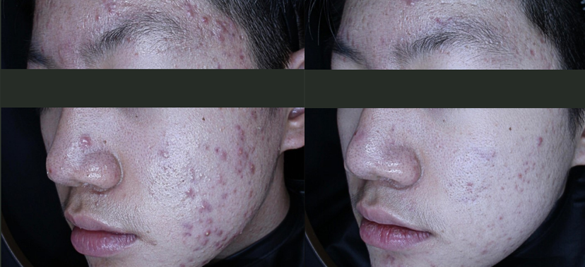 플래티넘PTT 치료사례02