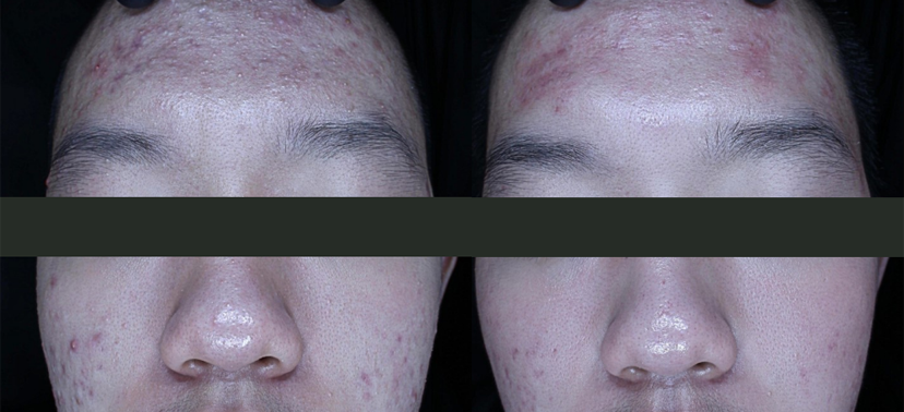 플래티넘PTT 치료사례04