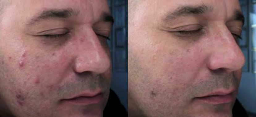 포토나 스타워커 치료사례05