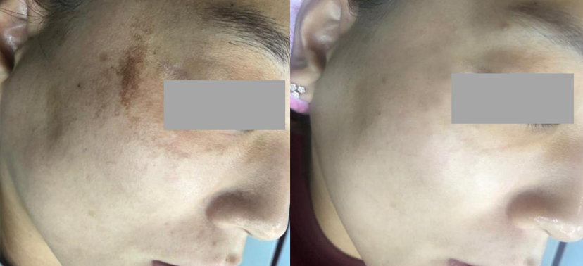 미인레이저 치료사례01