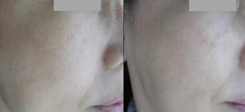 미인레이저 치료사례05