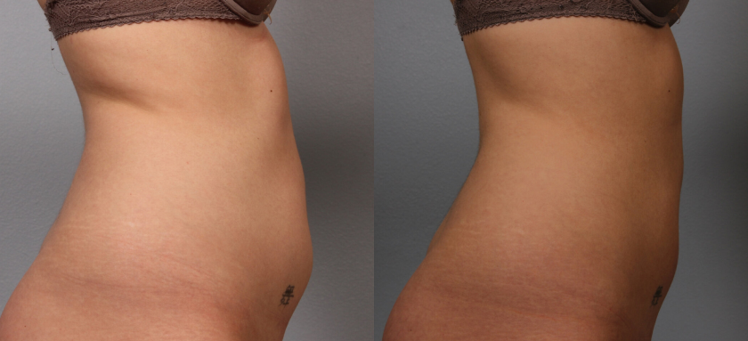 인모드 바디 치료사례03