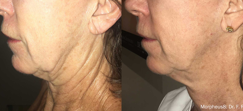 인모드 치료사례06