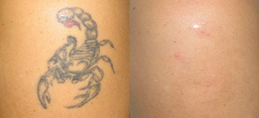 포토나 스타워커 치료사례02