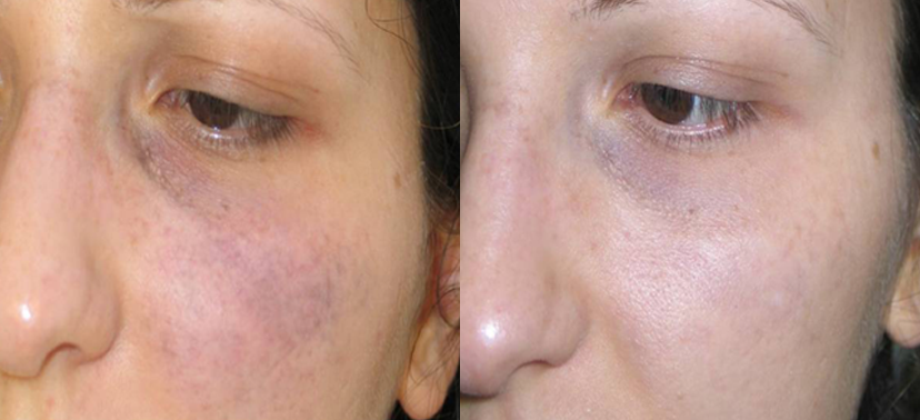 포토나 스타워커 치료사례03