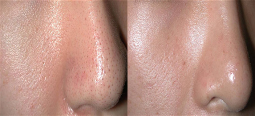 포토나 스타워커 치료사례04