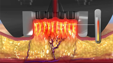 SMAS층 리프팅 지방세포 사멸