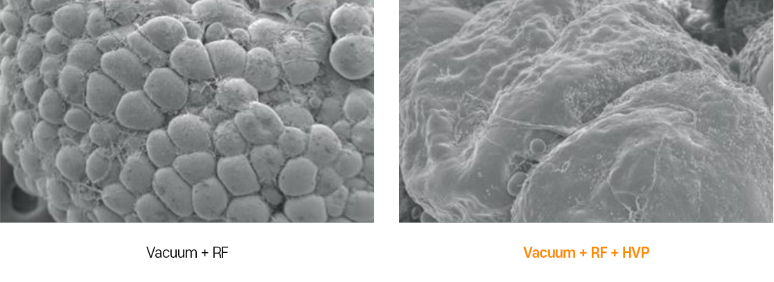 인모드 리프팅 핵심기술