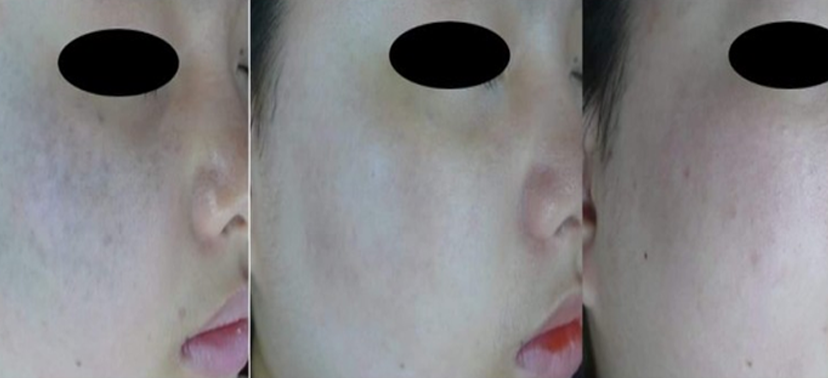 미인레이저 치료사례06