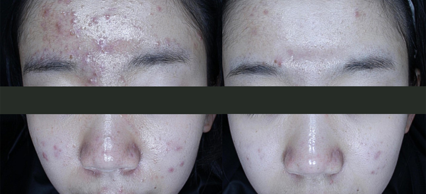 플래티넘PTT 치료사례03