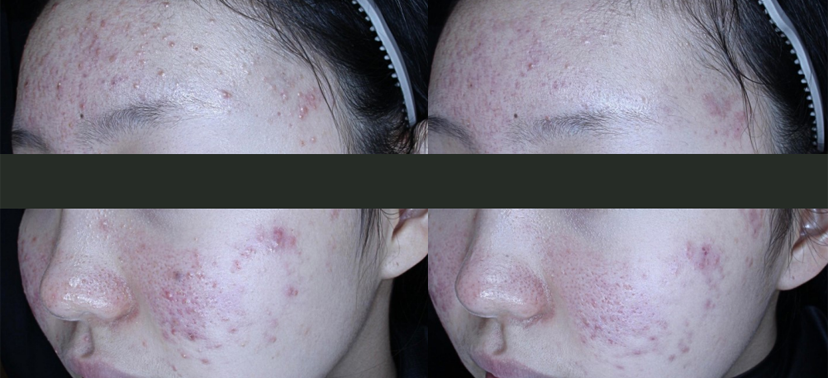 플래티넘PTT 치료사례05